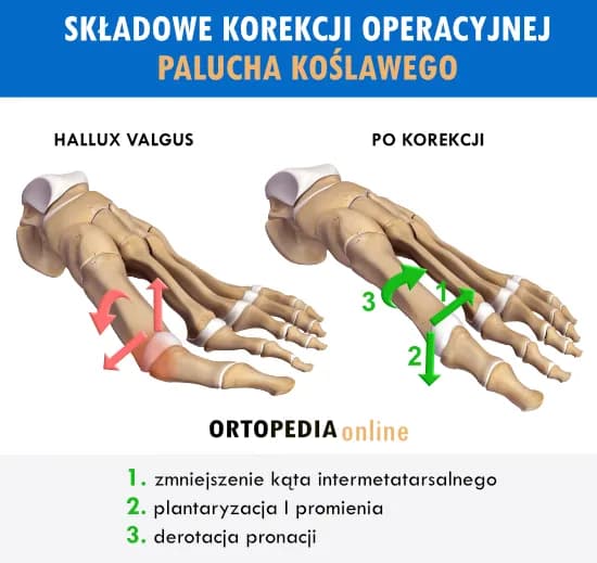 Leczenie haluksów: Kompleksowy przewodnik od domowych po chirurgiczne.