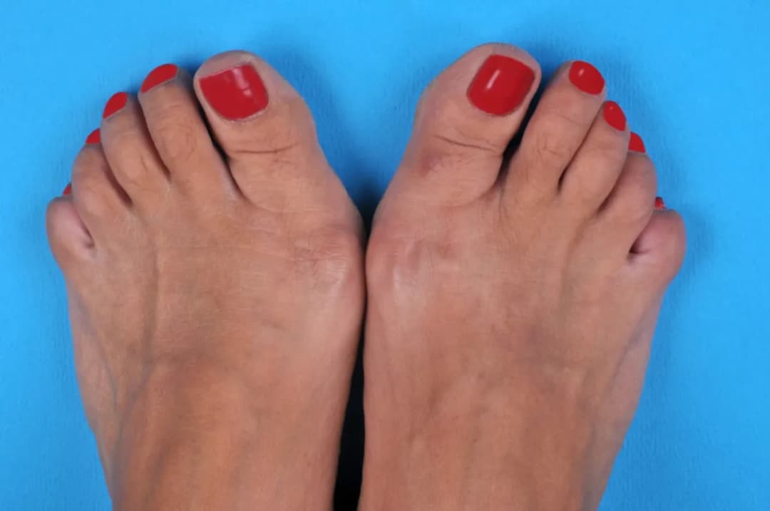 Haluksy: Jak raz na zawsze pozbyć się bólu i deformacji stopy?