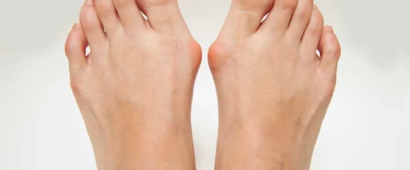 Od czego robią się haluksy? Genetyka, buty i nie tylko!