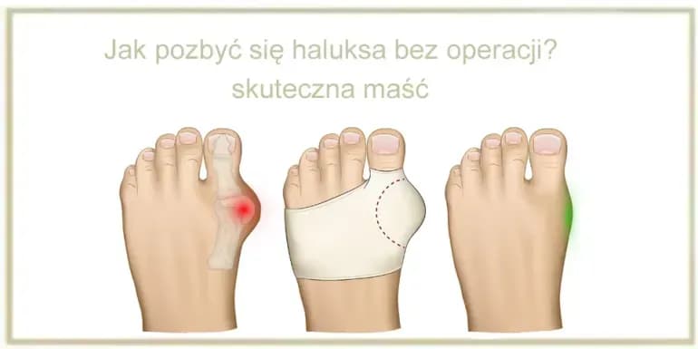 Bolące haluksy: Szybka ulga i skuteczne leczenie co działa?