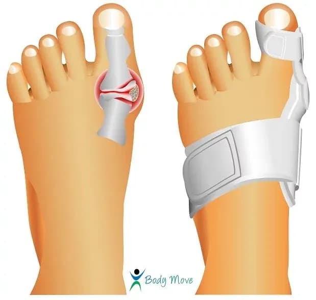 Co na haluksy do butów? Skuteczne sposoby na ból i komfort