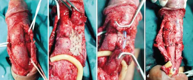 Zwężenie cewki moczowej: Leki czy zabieg? Prawda o leczeniu