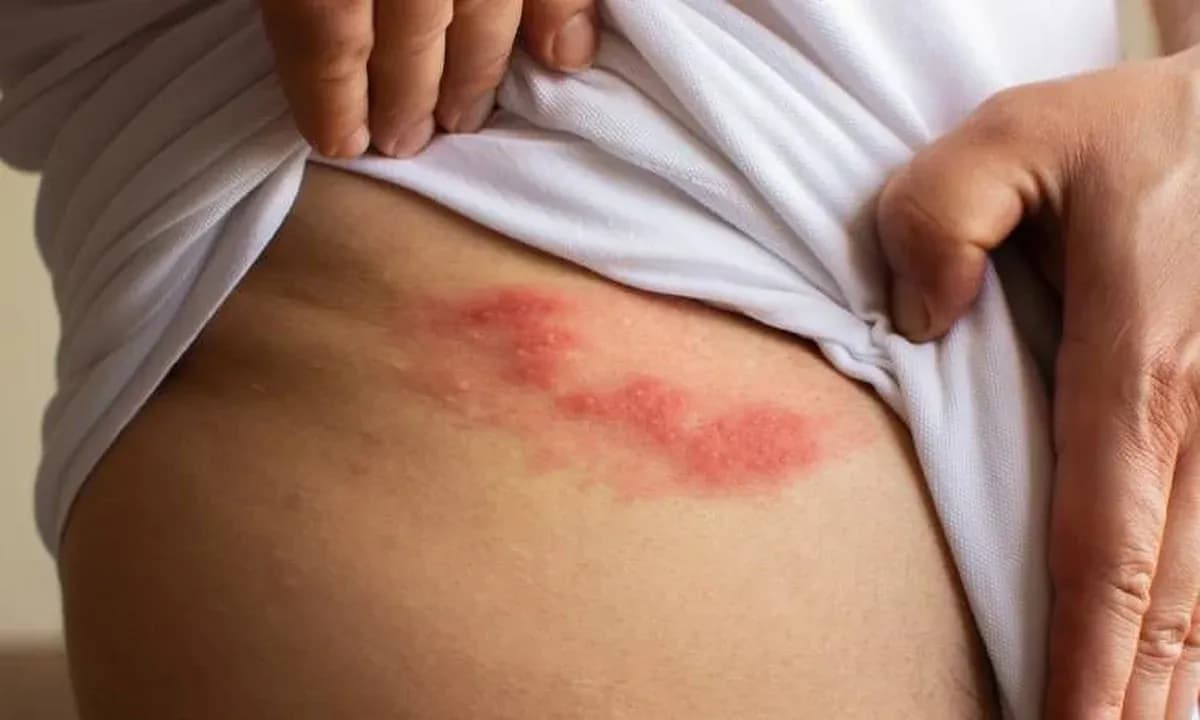 Półpasiec: Leki, ból, neuralgia jak skutecznie leczyć i zapobiegać?