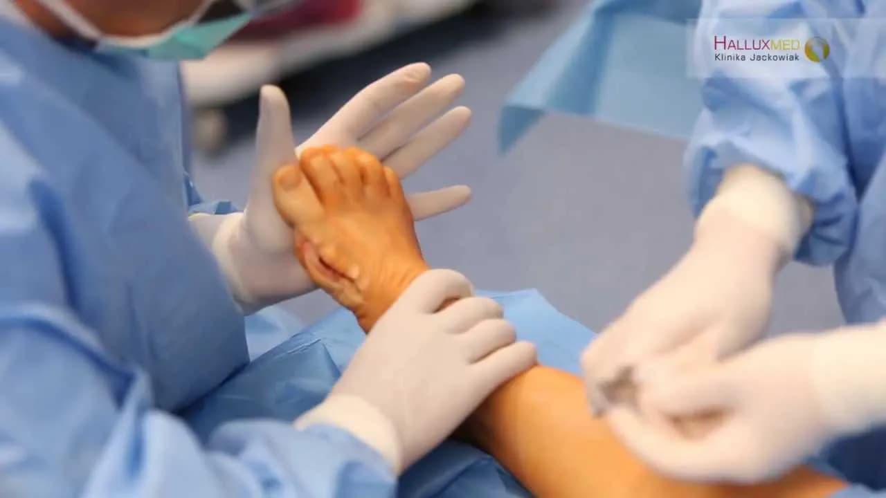 Jak wygląda operacja haluksa? Przewodnik od A do Z dla pacjenta
