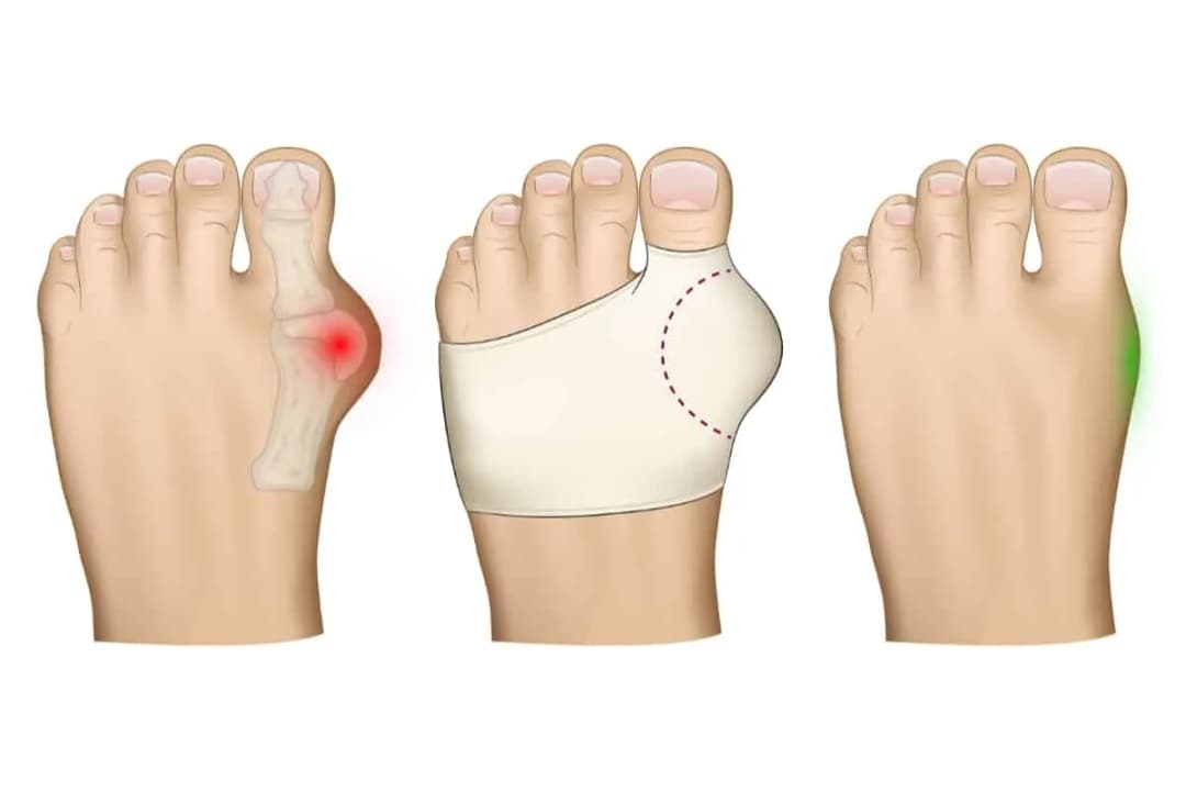 Jak pozbyć się haluksów? Pełny przewodnik po leczeniu i ulga