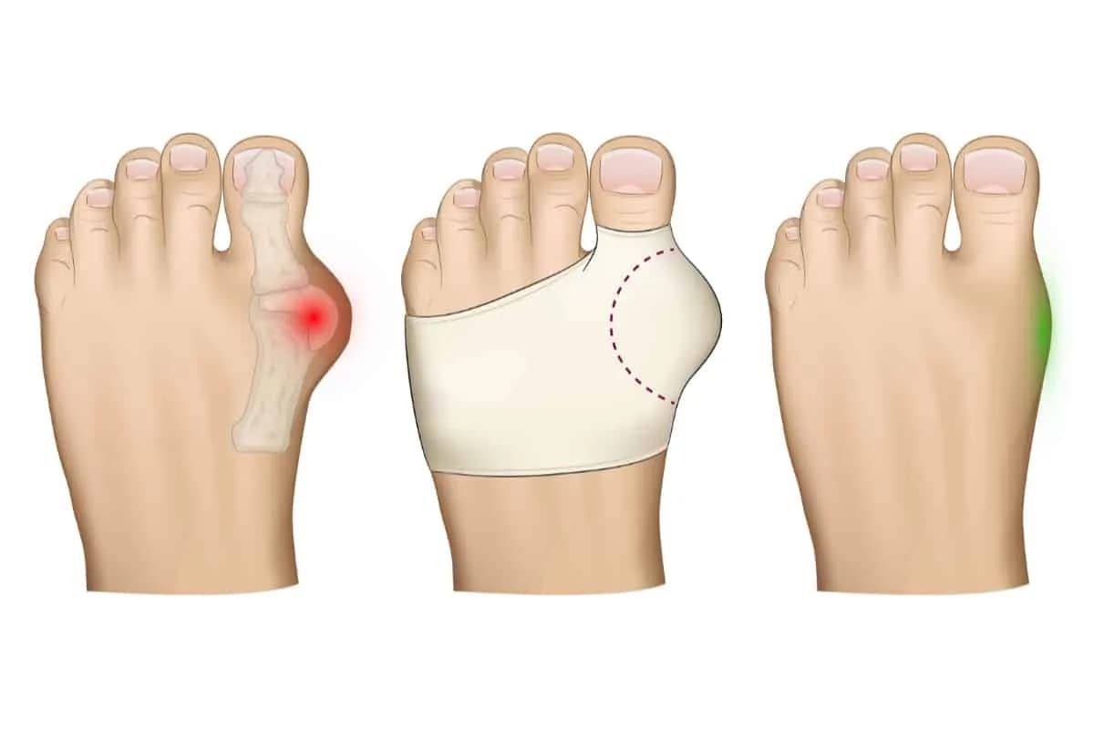 Jak pozbyć się haluksów? Pełny przewodnik po leczeniu i ulga